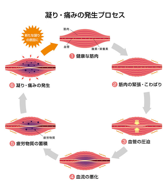 凝り・痛みの発生プロセス