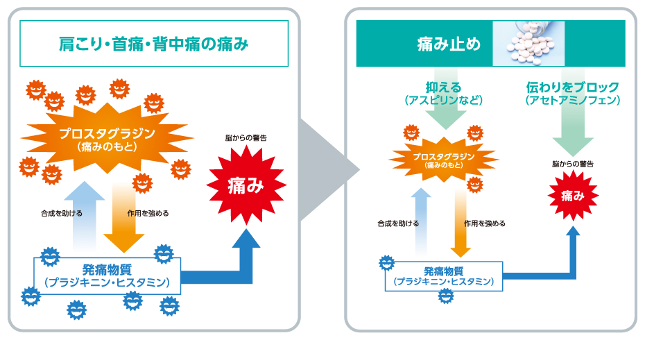 くすりで腱鞘炎を抑える仕組み