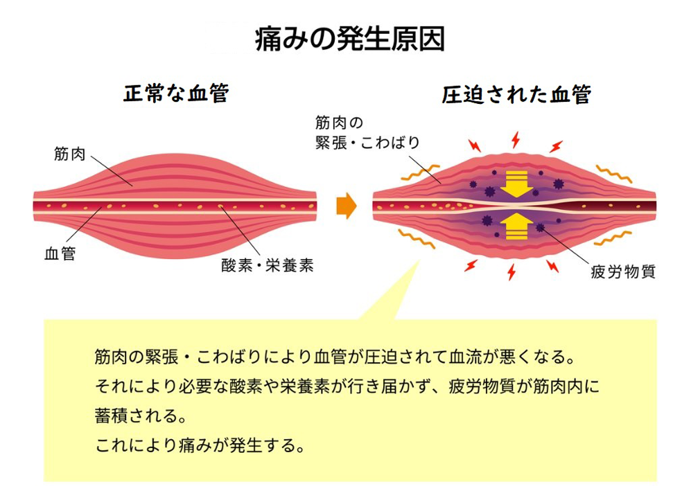 痛みの発生原因