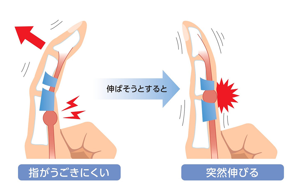 バネ指のチェック法