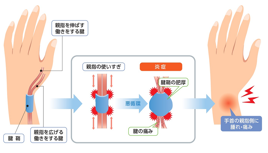 親指の腱鞘炎（ドケルバン病）の症状