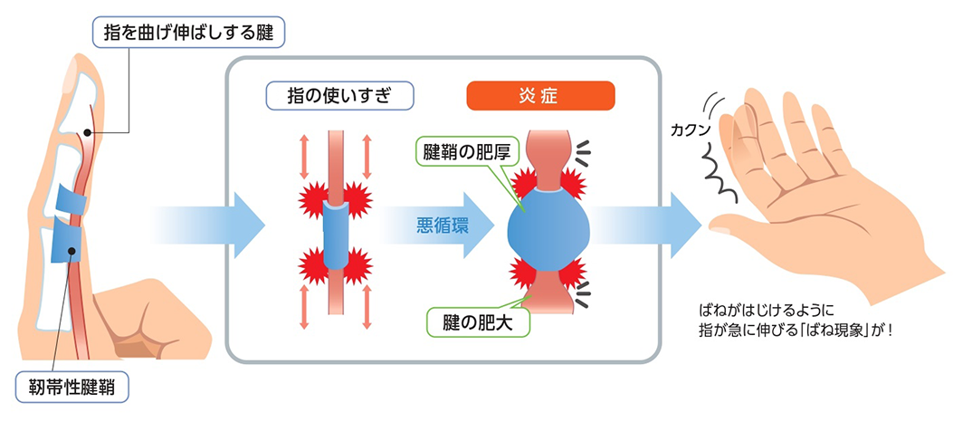 バネ指の症状